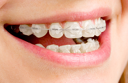 大牟田・アルファ歯科・矯正歯科