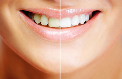 大牟田・アルファ歯科・ホワイトニング